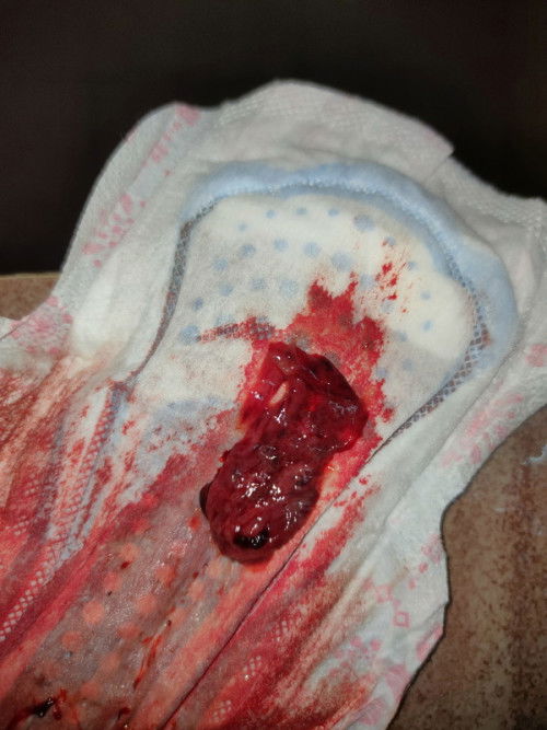 Period normal atau keguguran ye?