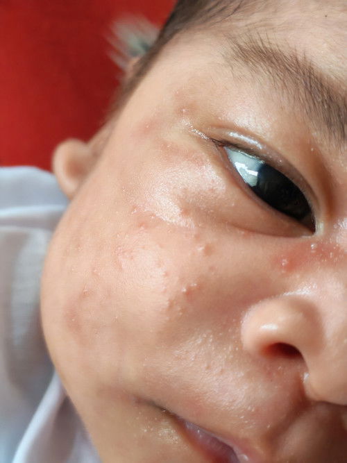 Ano po tawag sa mga little pimples growing in my LO face po?