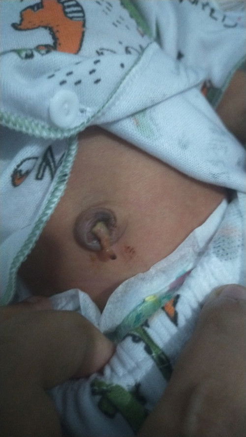 copot tali pusar bayi