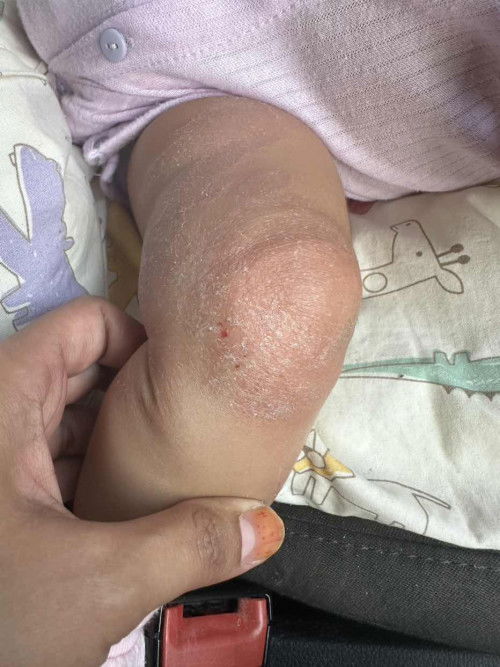 klau cmne kna apa ya?aczema ka?or kurap?