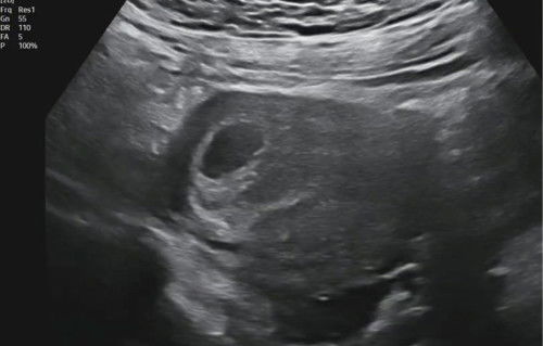 แบบนี้ปกติไหมคะ 6+4 ไม่เจอน้อง เจอแต่ถุงไข่แดงจางๆ