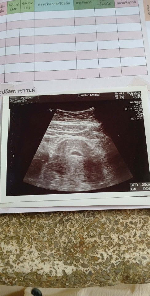 แม่บ้านไหนเป็นบ้างค้ะไปซาวครั้งแรกเจอแต่ถุงตั้งภรรค์แอบกลัวเป้นท้องลมมากๆเลยค้ะ