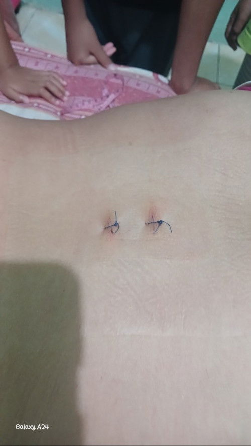 Bolehkan memakai korset lumbal di usia kehamilan 5 minggu