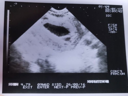 Flek seminggu + darah segar (sedikit) + kram