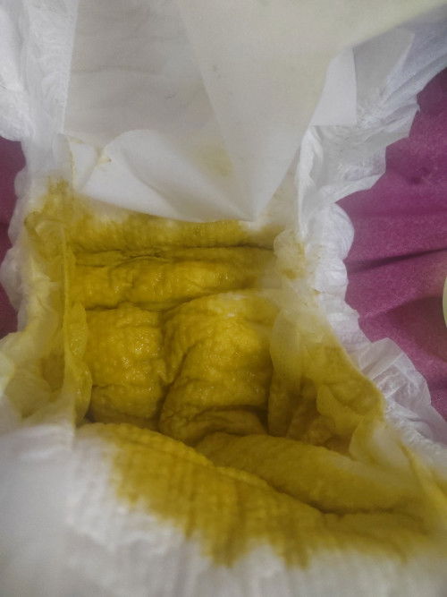 Hi ibu2... Anak cirit begin sehari dah 8x... Demam xde spo2 ok..
any suggestions utk stop cirit x