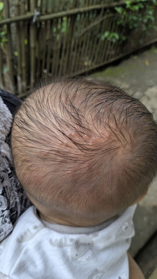 ada yang tau ini kenapa. Bayi 1 thn ku gatal garuk garuk terus.

kira kira pake obat apa yaa