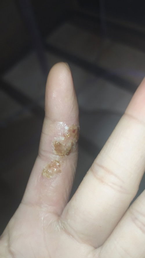 Luka karena gatal di jari tangan