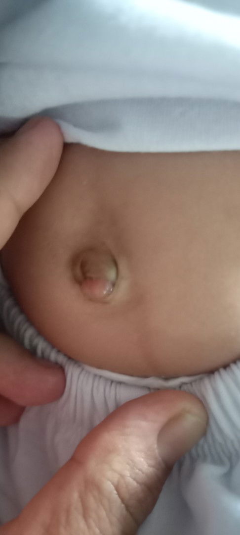 Pusar bayi belum kering dan muncul seperti daging dari dalam pusar