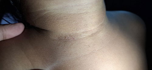 Leher mudah berkeringat dan bintik²