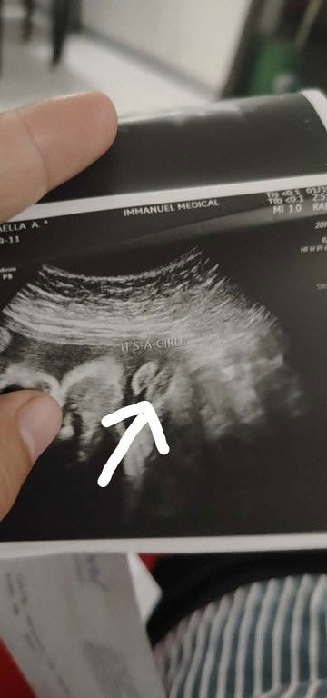 Ultrasound gender