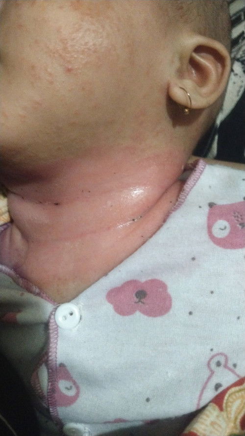 Bun anak saya ginih mukanya bintik merah seluruh badan badannya demam, lehernya ginihh
Apah yh solus