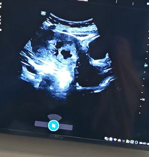 Kantong kehamilan tidak beraturan