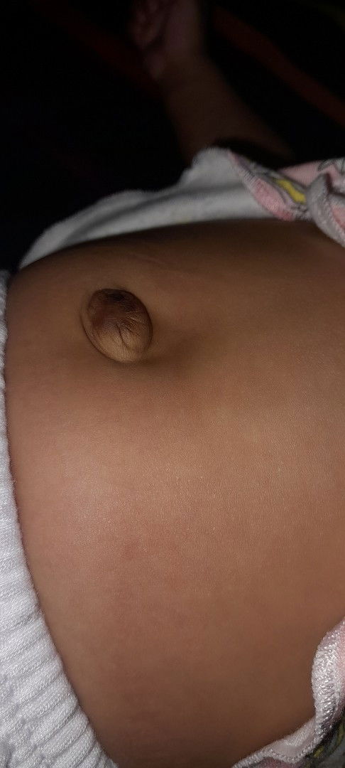 anak usia 2 bulan masih bodong