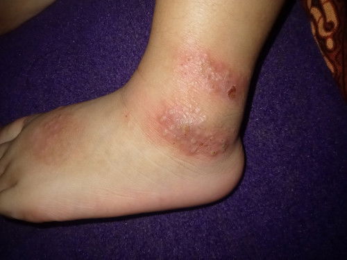 Apa ini scabies/kutu air/flu singapure