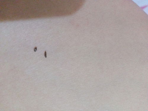 Puting payudara keluar kerak hitam dan lembek