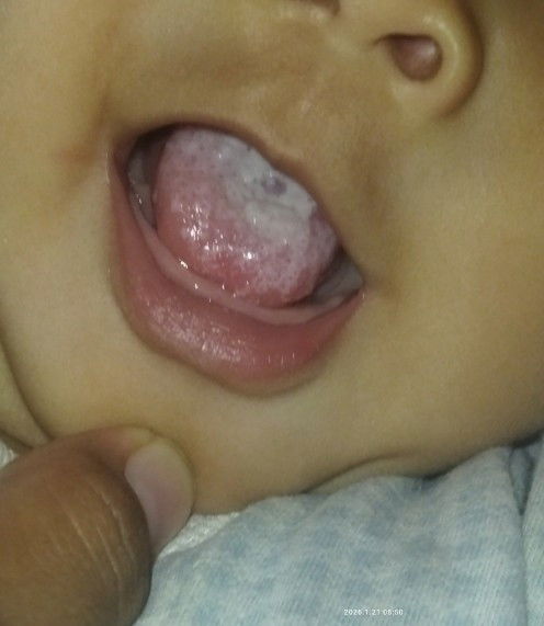 Bunda, tolong saran nya, bayi 7 bulan lidah putih tidak hilang, sudah di bersihkan pakai Kassa.