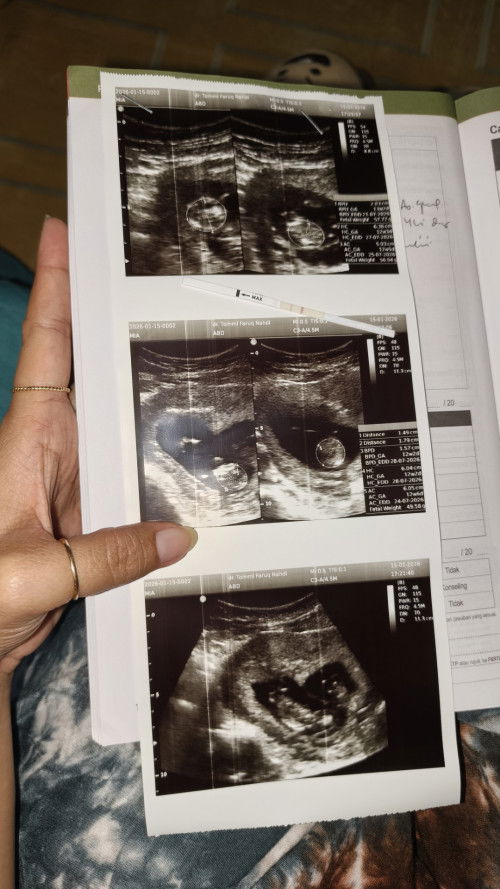 Saat ugs dokter mengatakan aku memiliki bayi kembar tpi di aplikasi tidak bisa menambahkan bayi?