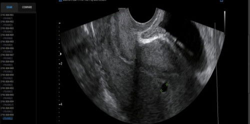 Ada yang pernah usg trans vaginal tidak ?