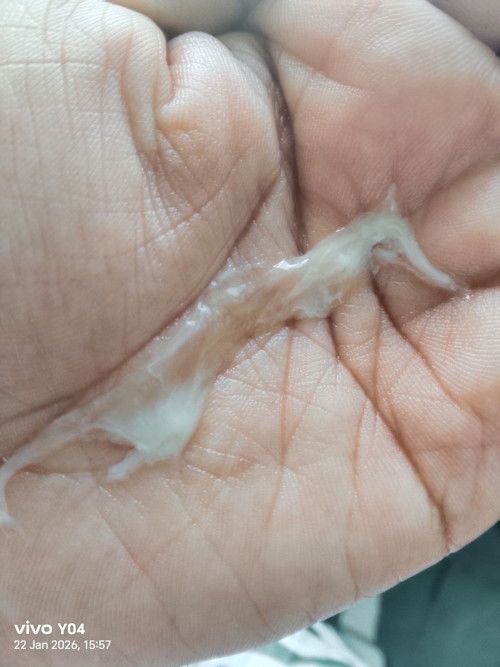 Keputihan campur darah kecoklatan