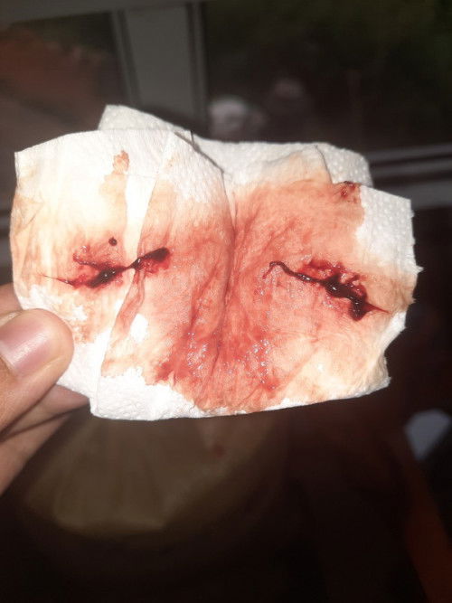 Is this normal po after IE.?