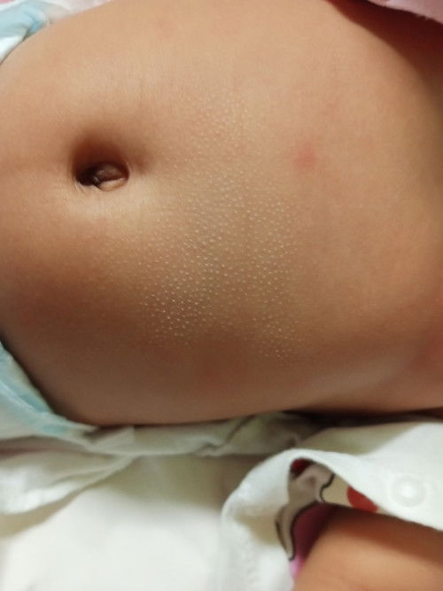Bintik2 di perut baby