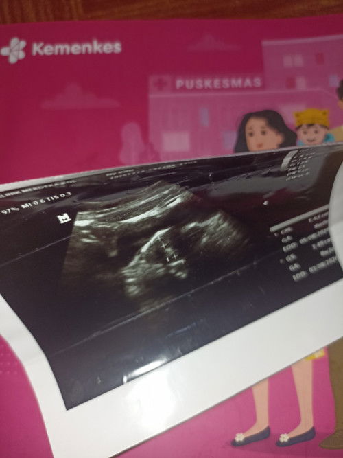 Hpht 12week hasil usg masih 8week normal ngga
Usg pertama katanya 8 week sebulan kemudian usg lagi