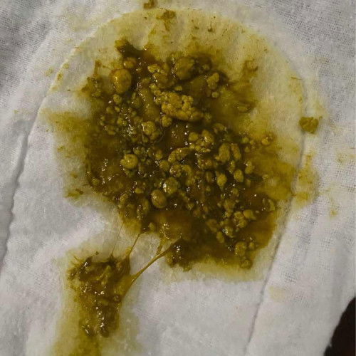 น้องอายุ24วัน อึแบบนี้ปกติไหมค่ะหรือน้องท้องอืด น้องกินนมผง แม่ๆบ้านไหนที่ลูกอึแบบนี้บ้างช่วยแนะนำหน่อยค่ะ