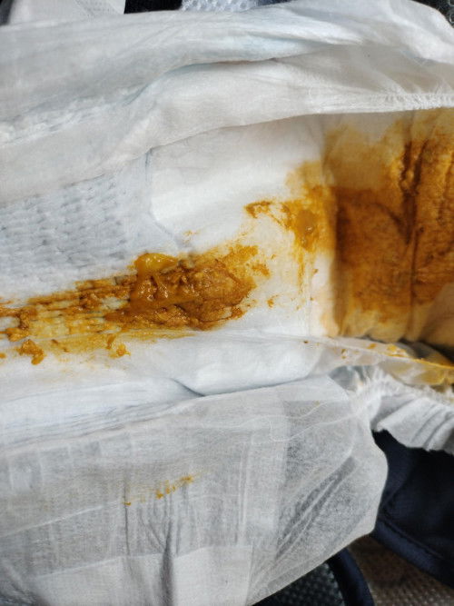 อึน้องเป็นแบบนี้ปกติมั้ยคะ