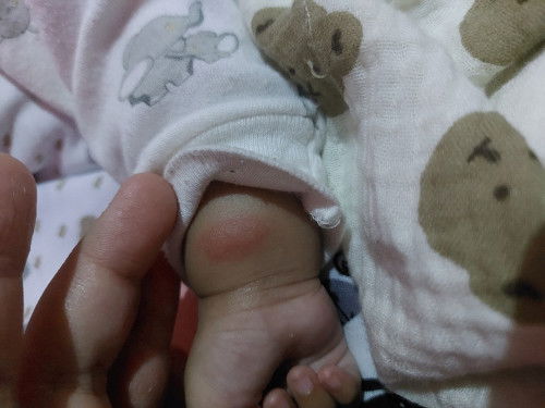 Bertanya mengenai bentol