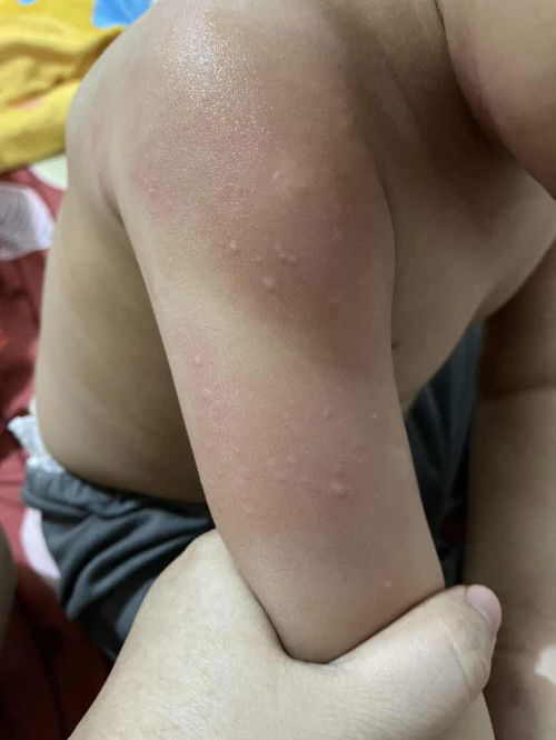 Tolong anakku bentol2 kecil gatal seperti digigit nyamuk