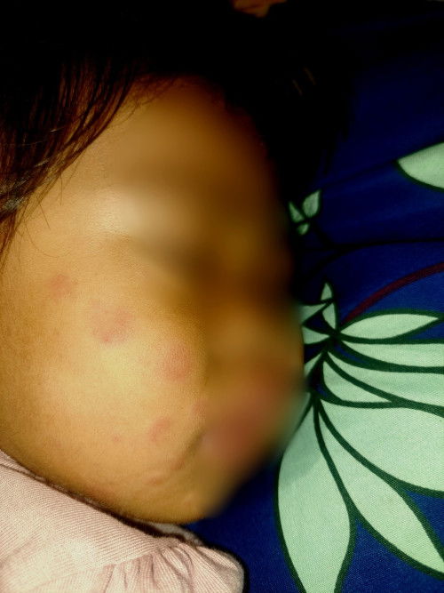 Ruam pada anak 16 bulan