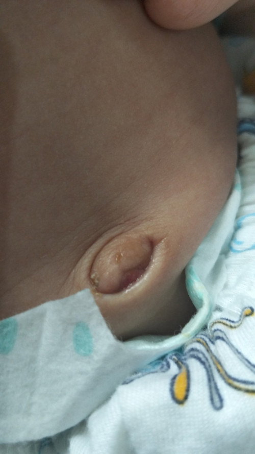 Puser bayi 1bln keluar seperti daging