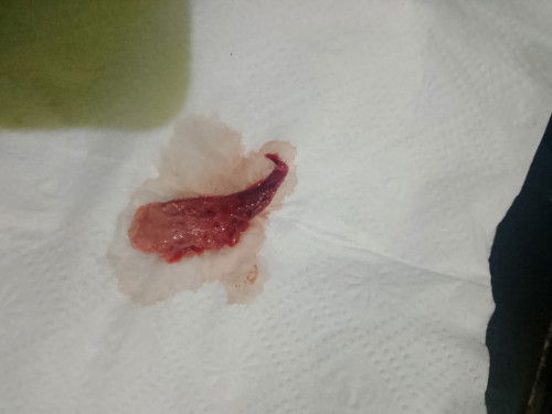 Ada yng pernah ngalamin kluar yang sperti ini GX di usia hamil 10 minggu