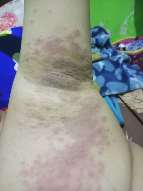 Gatal bercak merah katanya si hormon