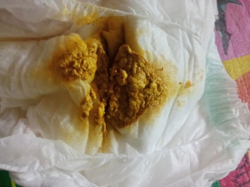 น้องกินนมผง อุจจาระแบบนี้ปกติไหมค่ะ