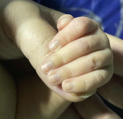 ต้นเล็บมีสีคล่ำ  น้องคลอดมา11 วันแล้ว