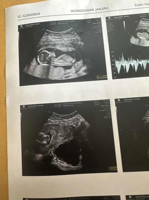 ใครเคย #ผ่าซีสที่รังไข่ขณะตั้งครรภ์ บ้างคะ🥹