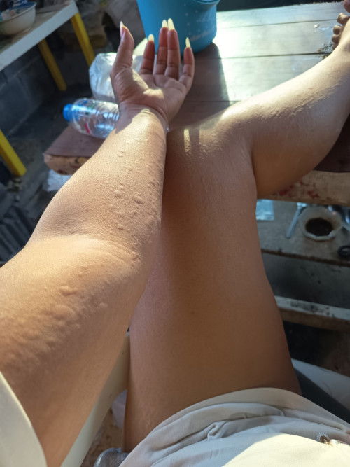 แม่ๆบ้านไหน มีผื่นขึ้นตามตัวแบบนี้ไหมค่ะ