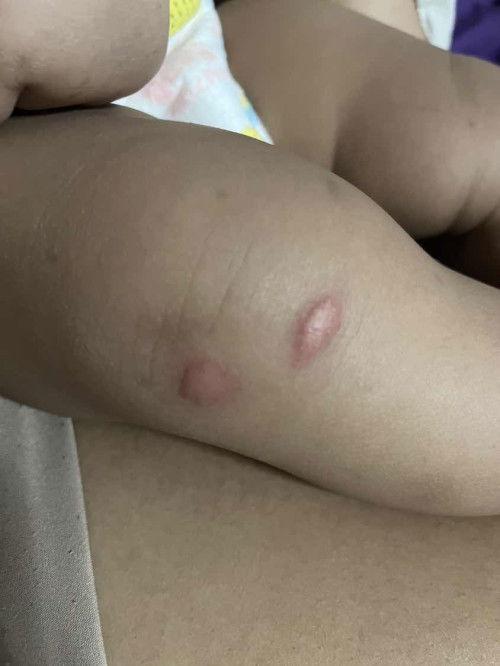 ตัวอะไรกัดคะแบบนี้