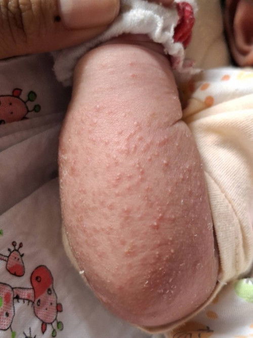 ผดผื่นขึ้นแบบนี้