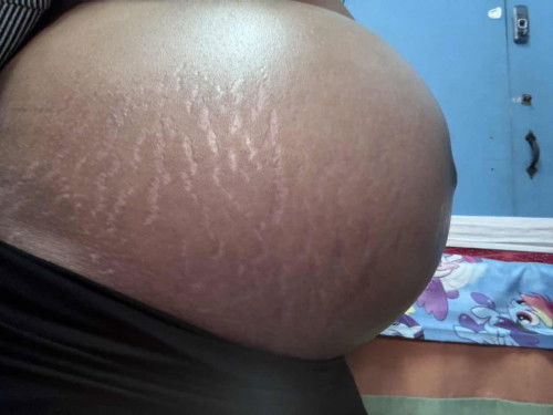 Stretch Marks