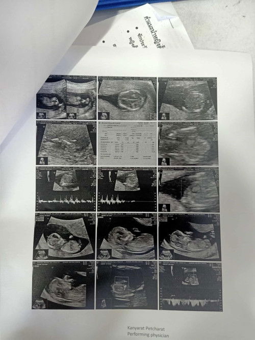 13w1d รู้เพศลูกหรือยังค่ะ