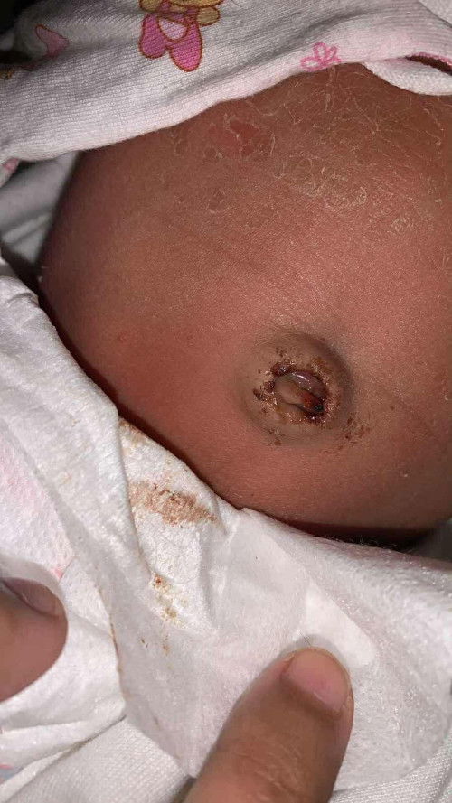 สะดืออักเสบบบ