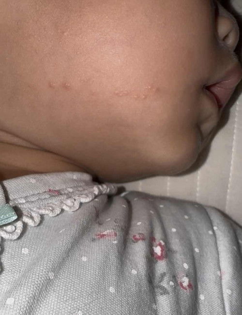 ตุ่มผื่นที่ปาก ใช้อะไรทาดีคะ