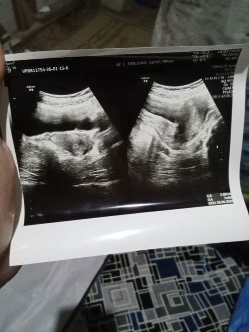 Ini masih ada janinya gk bun?