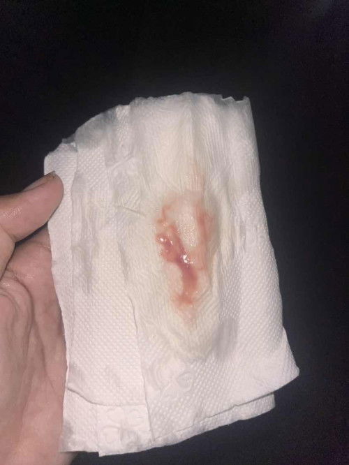 แบบนี้คือมูกเลือดใช่ไหมค่ะ