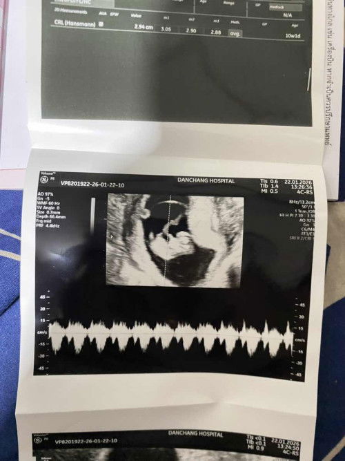 ท้องสองได้10W5Dท้องออกไวเหมือนกันมั้ยคะ