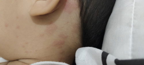Mom, anaknya ada yg pernah merah2 gini gak? Kira2 kenapa ya mom?