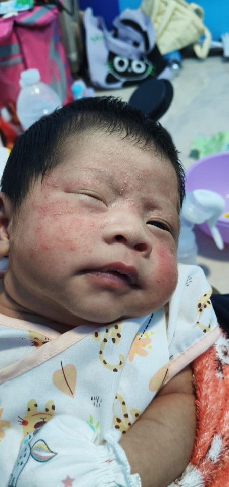 ผื่นขึ้นหน้า