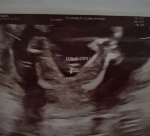 Apakah gender baby??